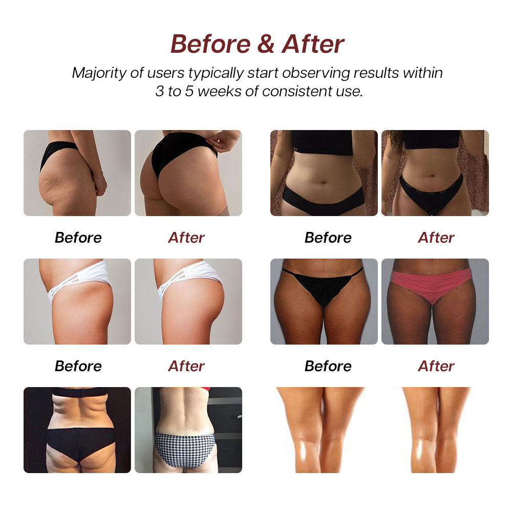 Renasculpt® Ems Rf Neo 5 Handle Ems Body Sculpting Machine