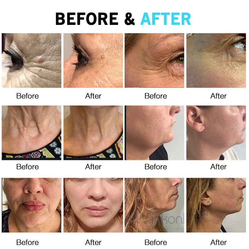 WINKONLASER 2025 Portable HIFU Machine  3D 4D 5D 7D 8D Painless Face Lifting & Body Slimming Device CE Certified