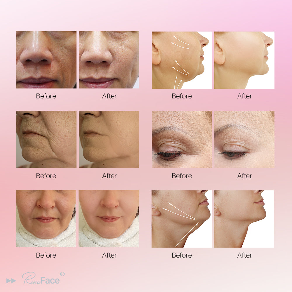 Renaface® RF Electromagnetic Face Lifting Sculpting Machine Price